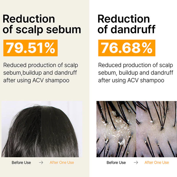 ACV Vinegar Shampoo