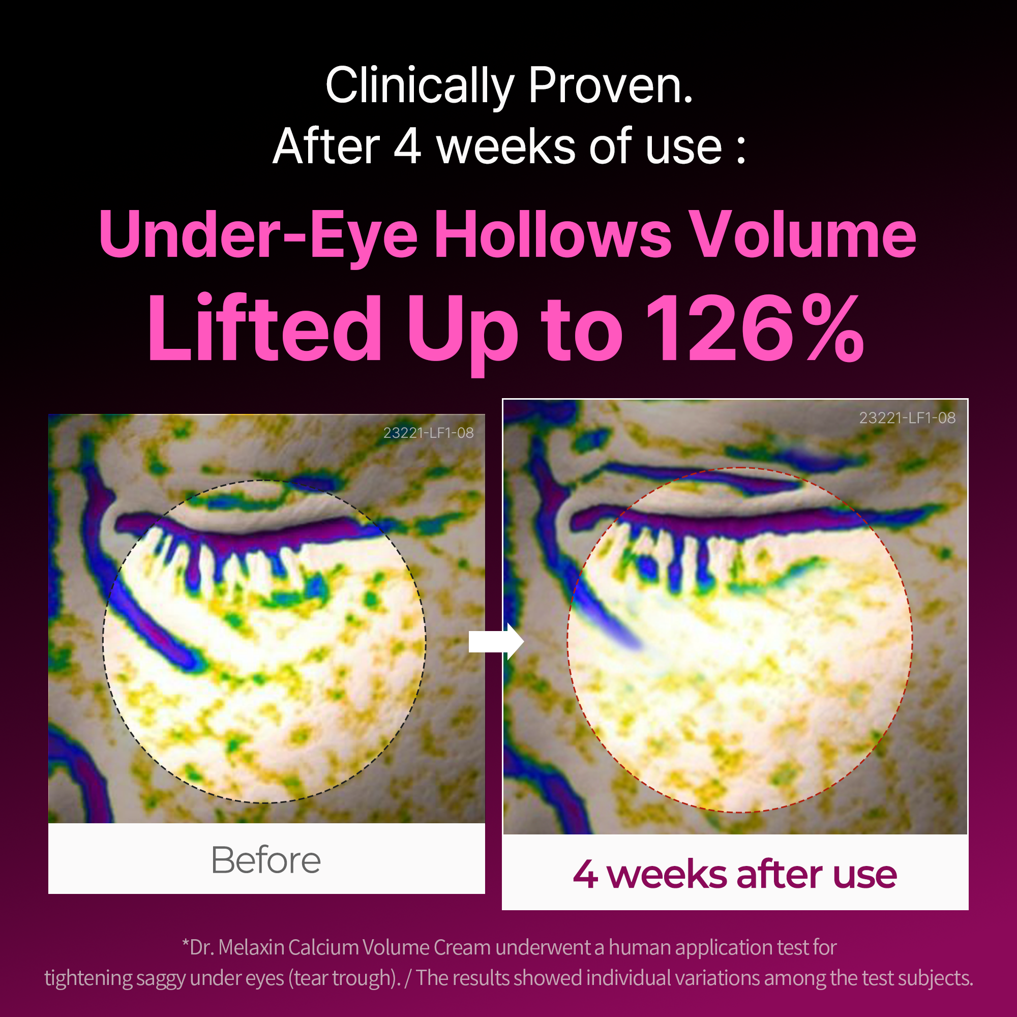 Calcium Volume Serum
