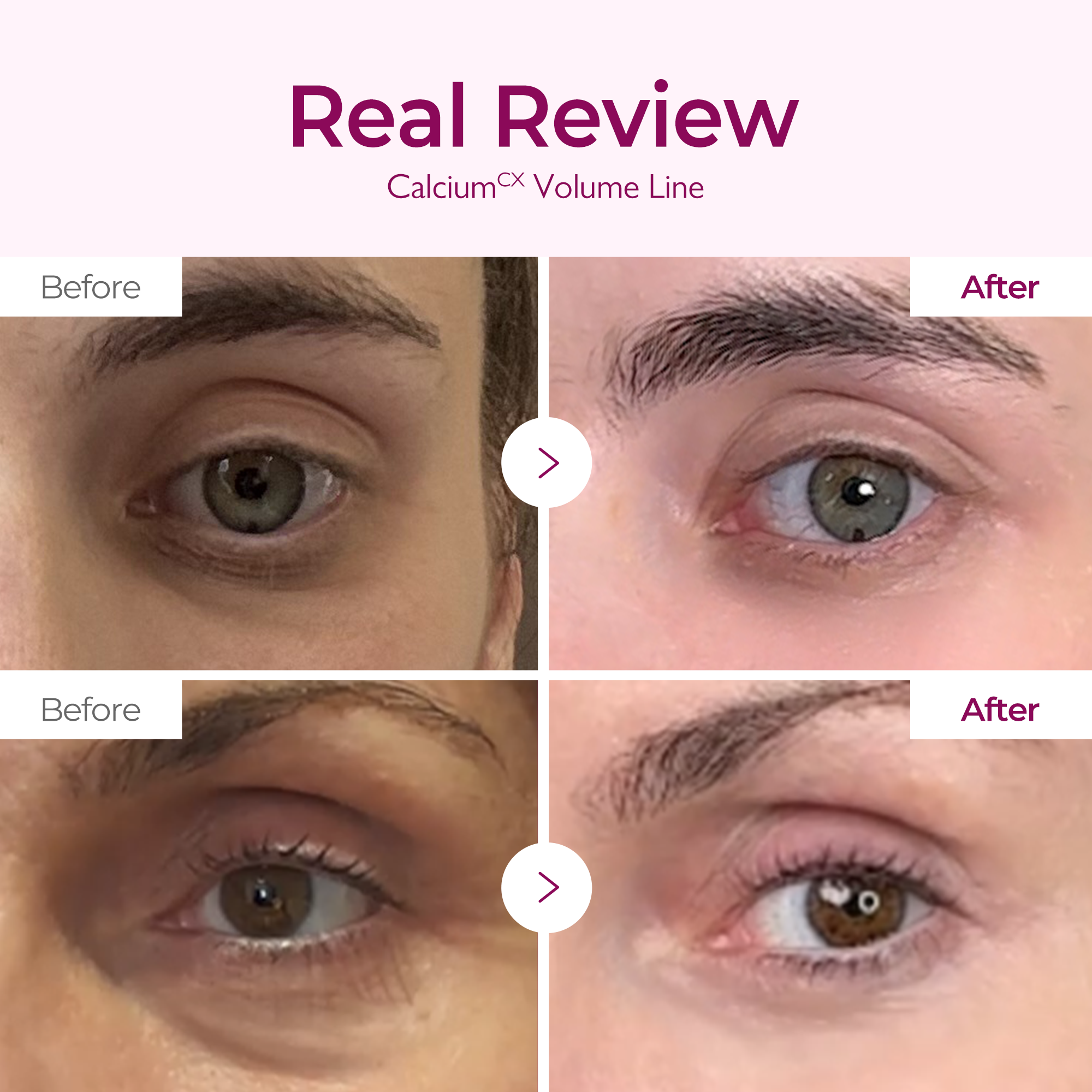 Calcium Volume Serum